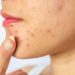 Conceptual of acne problems on woman skin.